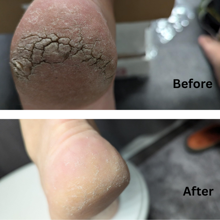 SwissCure Duo – Callus Remover & Urea Cream for Soft, Smooth Feet!