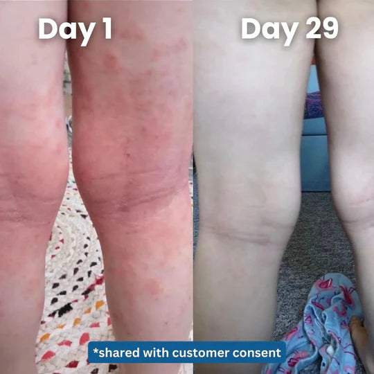 Soothing Eczema Relief Cream