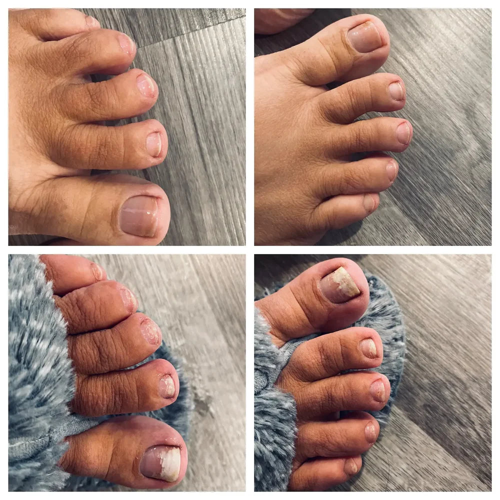 SwissCure™ - Votre chemin vers des ongles plus sains