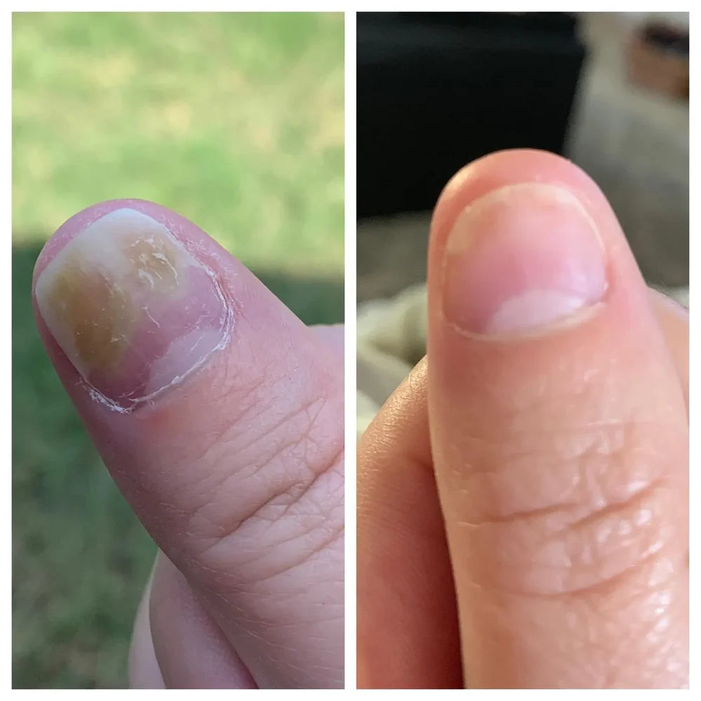 SwissCure™ - Votre chemin vers des ongles plus sains