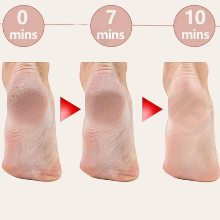 SwissCure Duo – Callus Remover & Urea Cream for Soft, Smooth Feet!