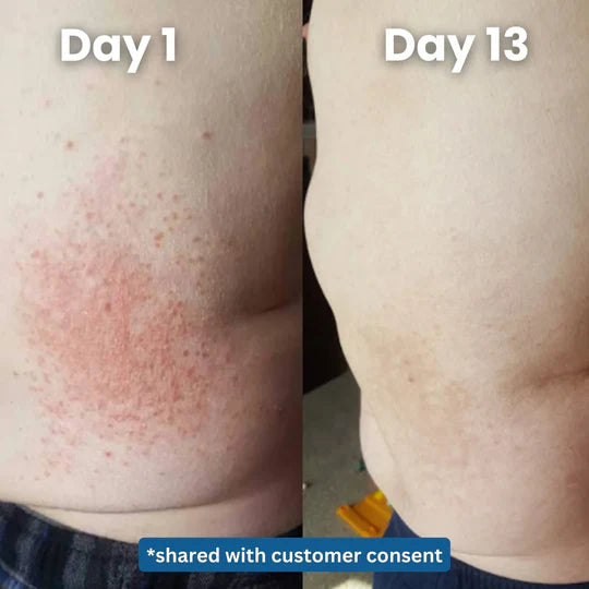 Soothing Eczema Relief Cream