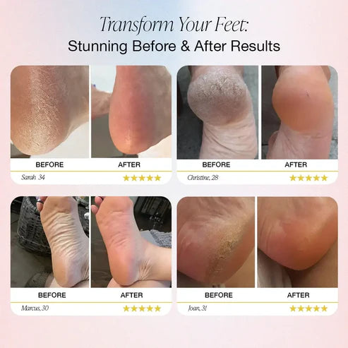 The Ultimate Electric Callus Remover: Smooth, Soft Feet in Just Minutes
